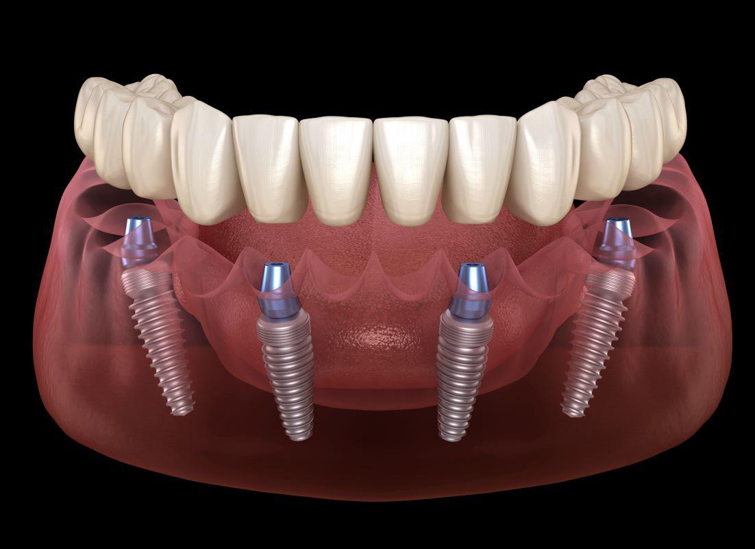 All-On-4 Implants Sandy Springs, GA