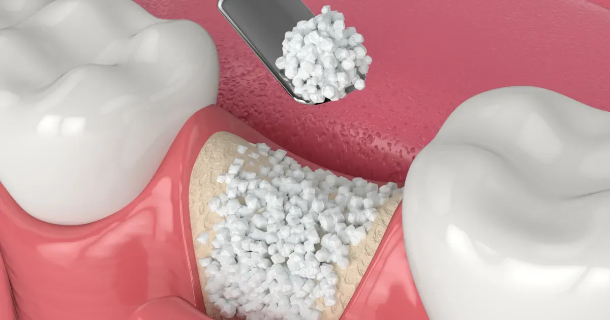 What is Bone Grafting and Why Do You Need It?