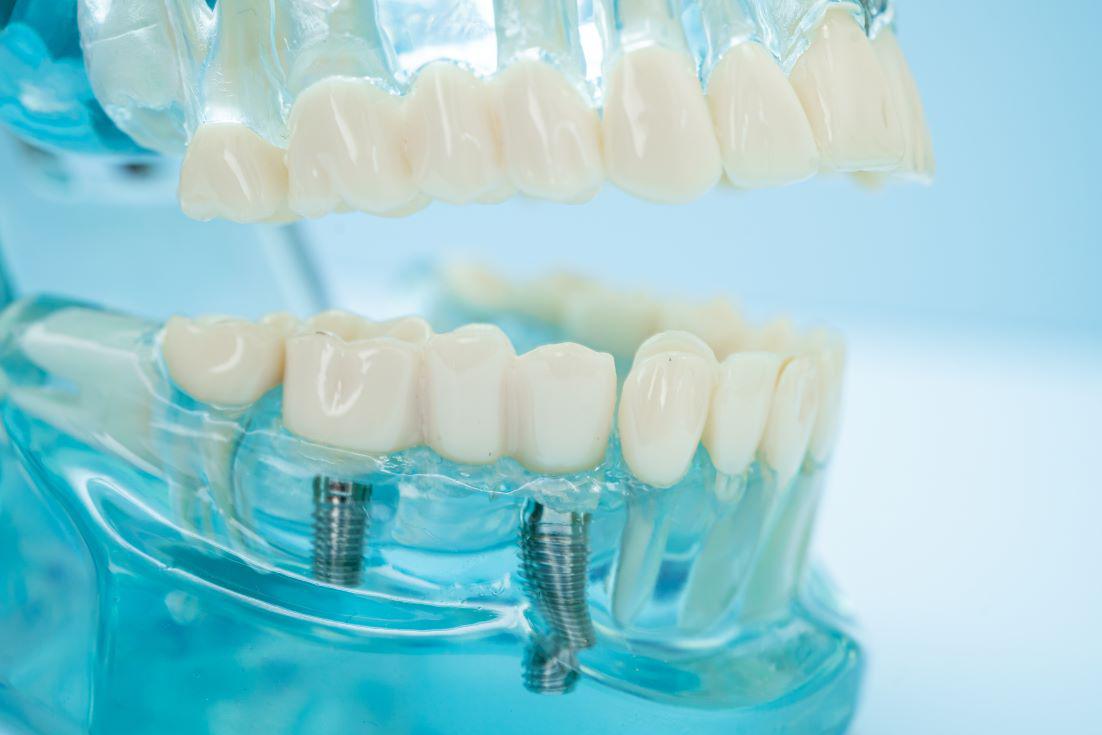 Dental Implants Sandy Springs, GA
