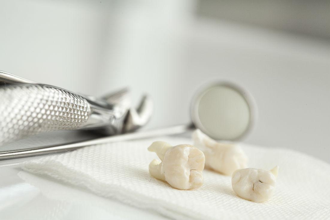 Tooth Extraction Sandy Springs, GA